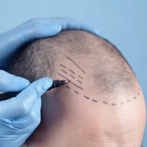Financing Your Procedure: Managing Hair Transplant Cost London