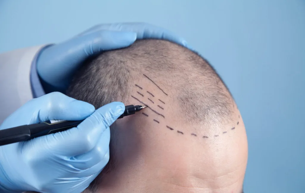 Financing Your Procedure: Managing Hair Transplant Cost London